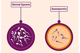 azoospermia-and-its-impact-on-male-infertility-blog-middle-1