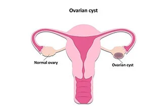 diminished-ovarian-reserve-dor-blog-middle-1