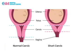 does-short-cervix-affect-your-pregnancy-blog-middle-1