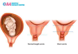 does-short-cervix-affect-your-pregnancy-blog-middle-2