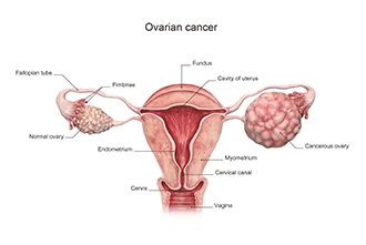 is-it-possible-to-get-pregnant-with-ovarian-cancer-blog-middle-1
