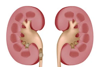 kidney-stones-blog-middle-1