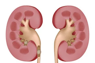 kidney-stones-blog-middle-2