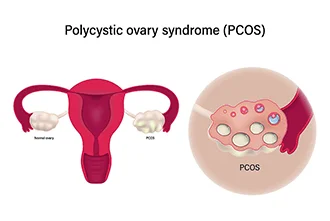 pcos-infertility-and-treatments-blog-middle-1