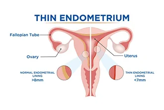 thin-endometrium-consequences-and-treatments-blog-middle-1