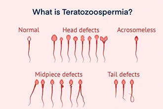 what-is-teratospermia-blog-middle-2